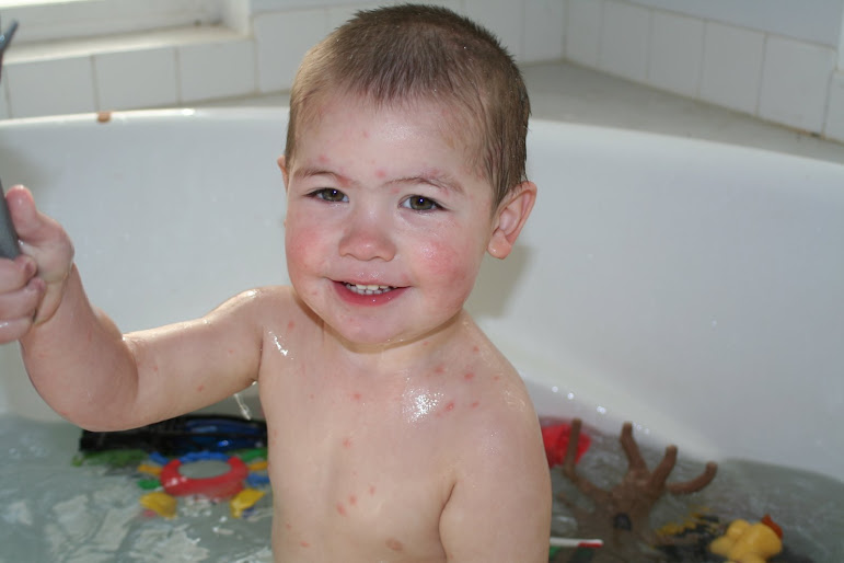 Steven Has The Chicken Pox
