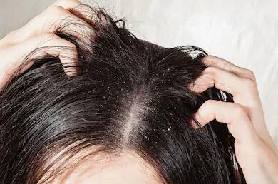 علاج قشرة الشعر المزمنة بالاعشاب