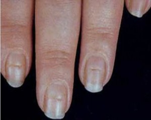 Vertical Nail Ridges And Thyroid@^*