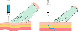 All about intramuscular (IM) injections