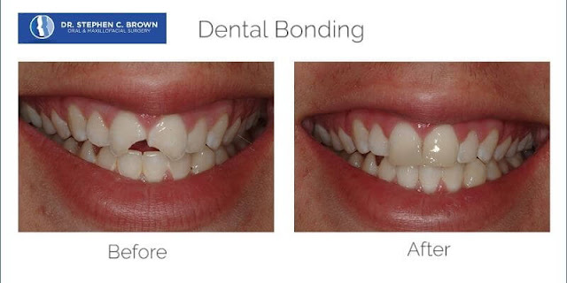 The Dental Reconstructive Surgery — Dental Bonding
