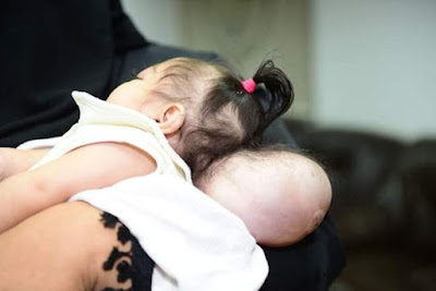 رئيس جامعة سوهاج يستجيب لعلاج طفلة مصابة بعيب خلقي نادر بالجمجمة
