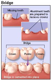 retainer dan gigi palsu