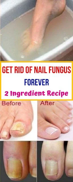 Get Rid Of Nail Fungus Forever – 2 Ingredient Recipe