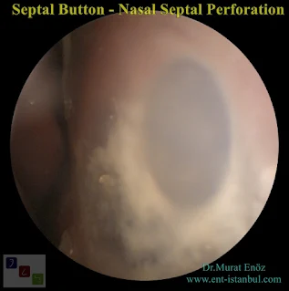 Septal Button - Nasal Septal Perforation