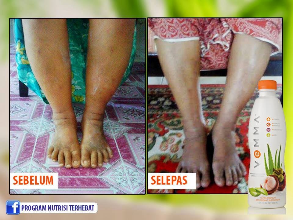 Vemma Kuantan: Kaki Bengkak Kerana Masalah Buah Pinggang 
