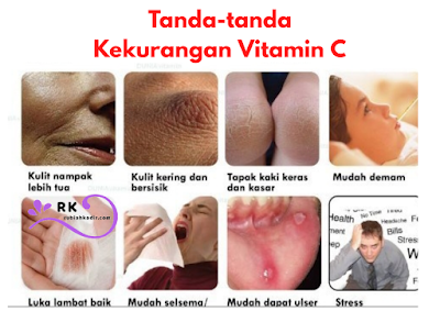 Tanda-tanda kekurangan Vitamin C