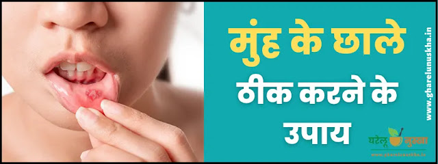 ways-to-cure-mouth-ulcers