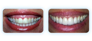 Boca Raton cosmetic Dentist Dr. Kenneth A. Mogell offers gum lifts to improve your gummy smile.