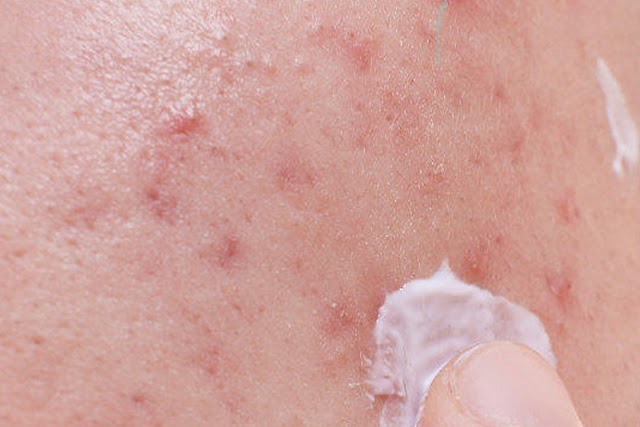 Is ZENMED Acne Treatment Worth a Try?
