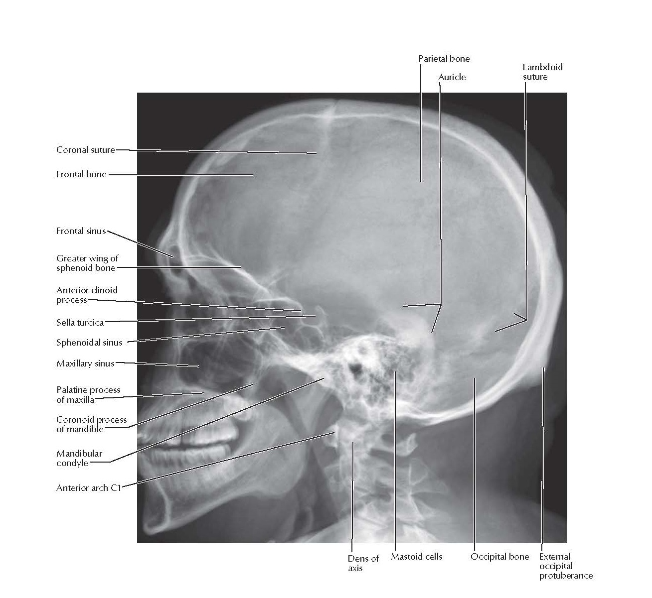Skull: Lateral Radiograph Anatomy