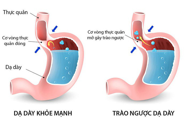 Hình ảnh trào ngược dạ dày thực quản