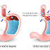 Mẹo khắc phục trào ngược dạ dày thực quản
