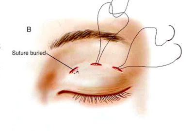 Nhấn mí mắt luồn chỉ là như thế nào