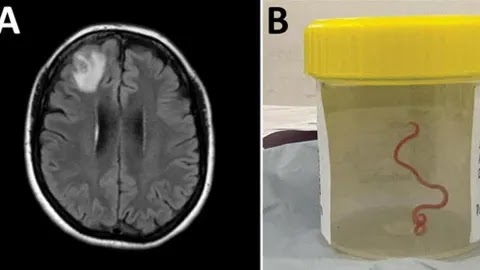 Shocking: Live 3-Inch Parasitic Worm was discovered and removed from Woman's Brain