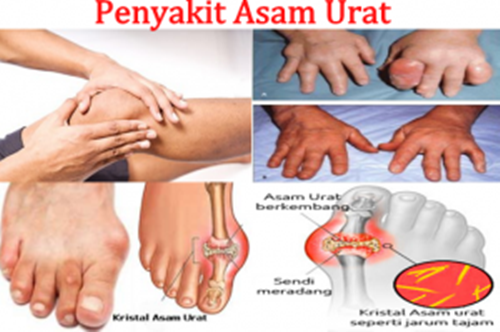 Resep Obat Asam Urat Dan Rematik