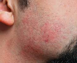 How to Get Razor Burn to Go Away