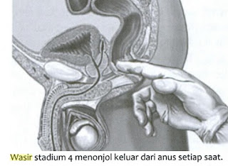 wasir terjadi lantaran beberapa faktor yang menciptakan kita berfikir untuk mencari obat ambeien  20 Obat Ambeien/Wasir Tradisional, Obati Ambeien Dengan Cara Alami 