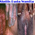 ciri dan penyebab penyakit sipilis