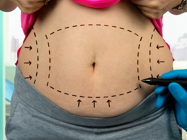 Should I Get Liposuction or a Tummy Tuck?