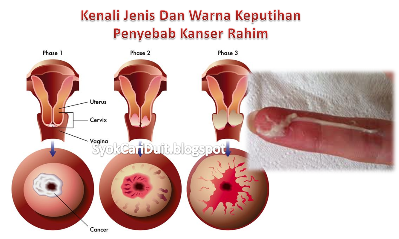 Kenali Jenis Dan Warna Keputihan Penyebab Kanser Rahim 