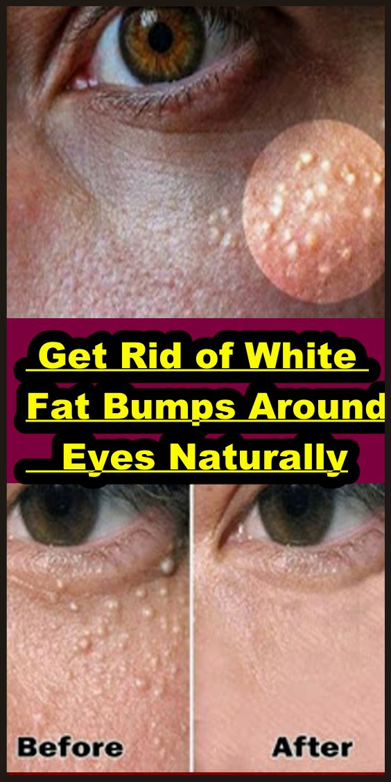 Get Rid of White Fat Bumps Around Eyes Naturally!!!