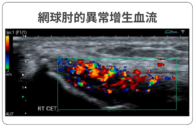 網球肘肌腱異常增生的血流