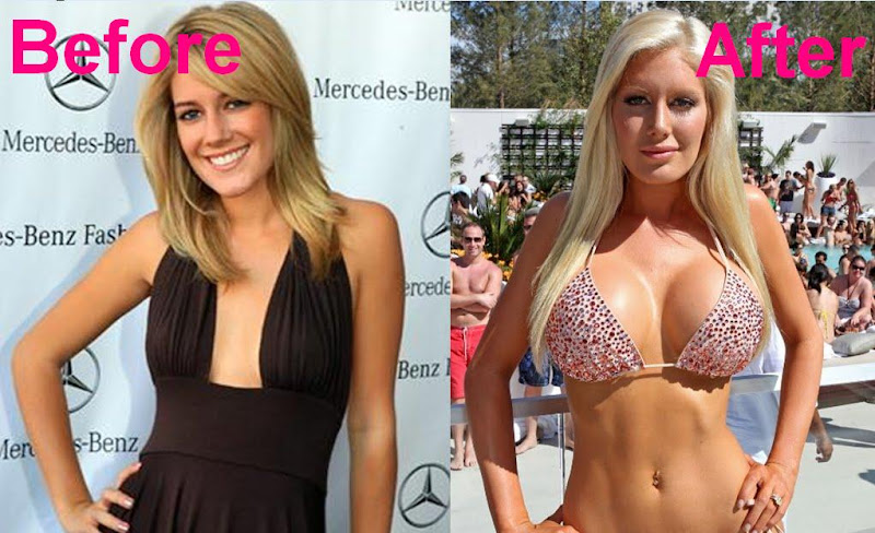 heidi montag before and after plastic surgery pictures. heidi montag before and after