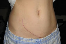 My Transplant Scar