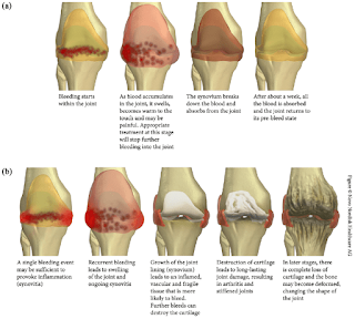 Bleeding within Joints