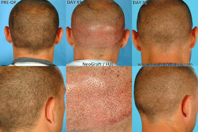 What is FUE hair transplant