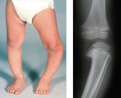 Paediatric Orthopaedics India: Blount's disease – Causes and Treatments