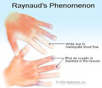 raynauds phenomenon symptoms