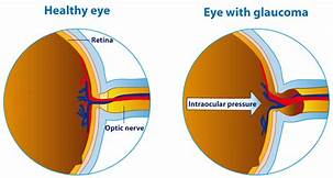 Glaucoma