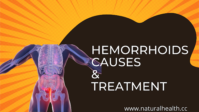 hemorrhoids causes and hemorrhoids treatment