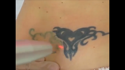 luz pulsada elimina tatuajes