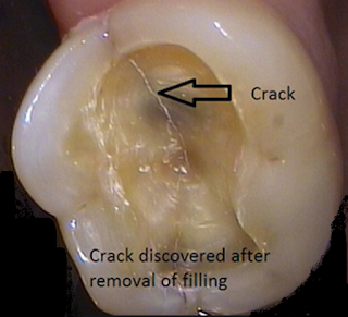 cracked fracture lines in teeth cracked molar