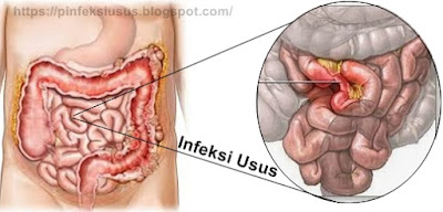 Apa Ciri Ciri Penyakit Infeksi Usus 