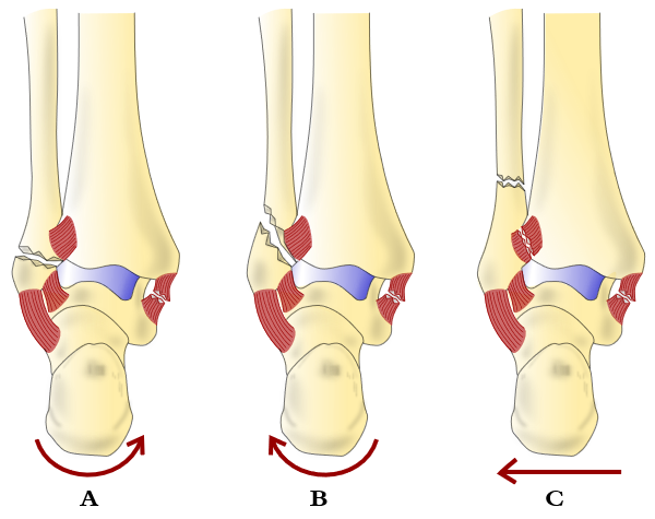 Weber fracture Classification - Weber A fracture,Weber B fracture,Weber C fracture - Treatment, surgery recovery time