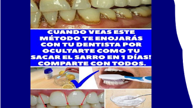 Tipos de Sarro Dental