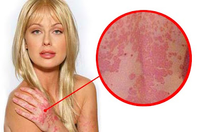 Is Psoriasis Contagious 