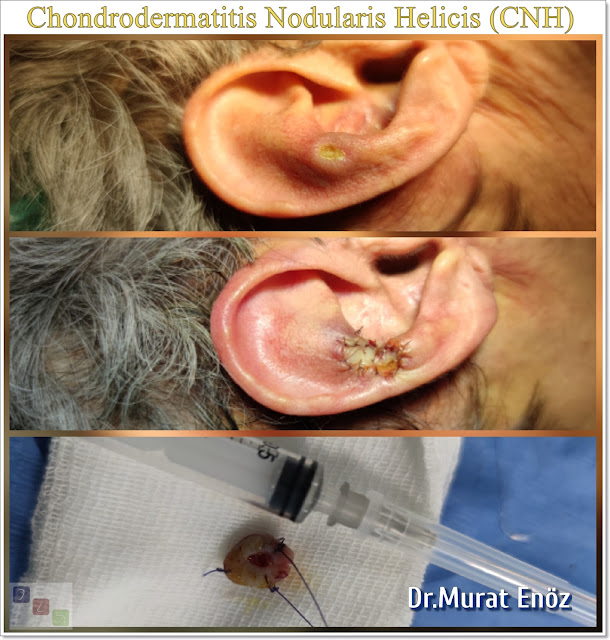 Chondrodermatitis Nodularis Helicis, CNH, Auricle lesion, Small tender nodule on the auricle