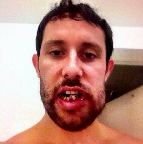 Sam-Gagner-Broken-Jaw-2013