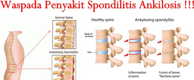 Image result for ankilosis pada sendi