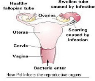  yaitu suatu peradangan pada peradangan tuba falopii Penyakit radang panggul (PELVIC INFLAMMATORY DISEASE/ PID)