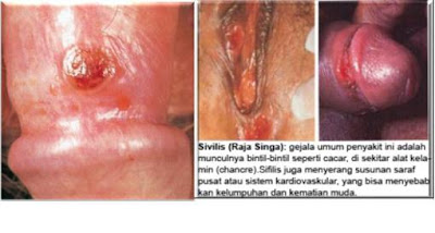 Harga Obat Sipilis Paling Manjur