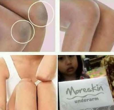 moreskin underarm