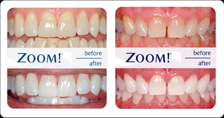 Teeth Whitening Gel