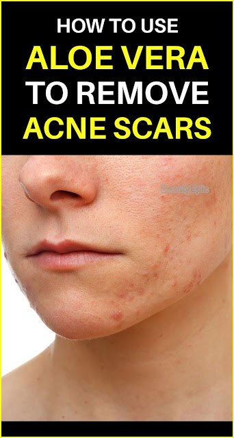 Aloe Vera for Acne and Acne Scars Treatment