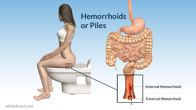 piles or hemorrhoids